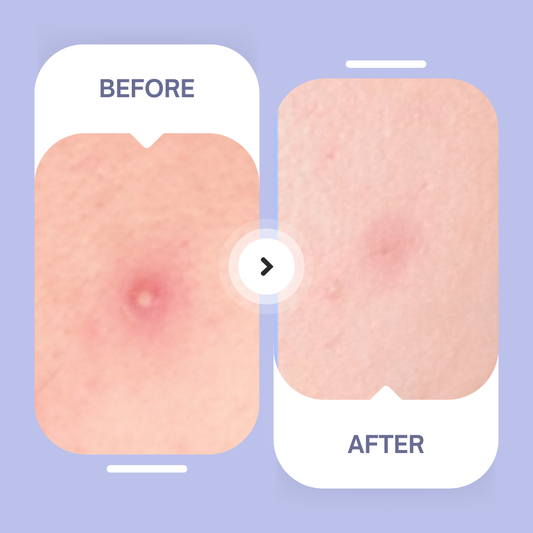 Maskeraide - Hydrocolloid Acne Patches – Overnight Blemish Treatment